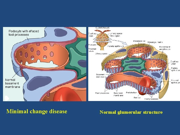 Minimal change disease Normal glumerular structure 
