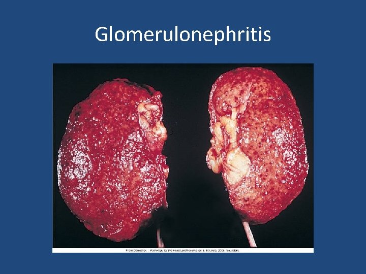 Glomerulonephritis 
