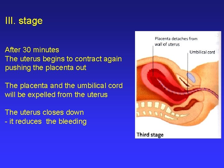 III. stage After 30 minutes The uterus begins to contract again pushing the placenta