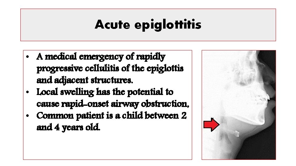 Acute epiglottitis • A medical emergency of rapidly progressive cellulitis of the epiglottis and