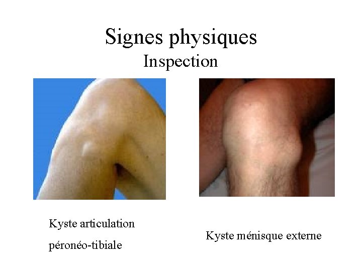 Signes physiques Inspection Kyste articulation péronéo-tibiale Kyste ménisque externe 