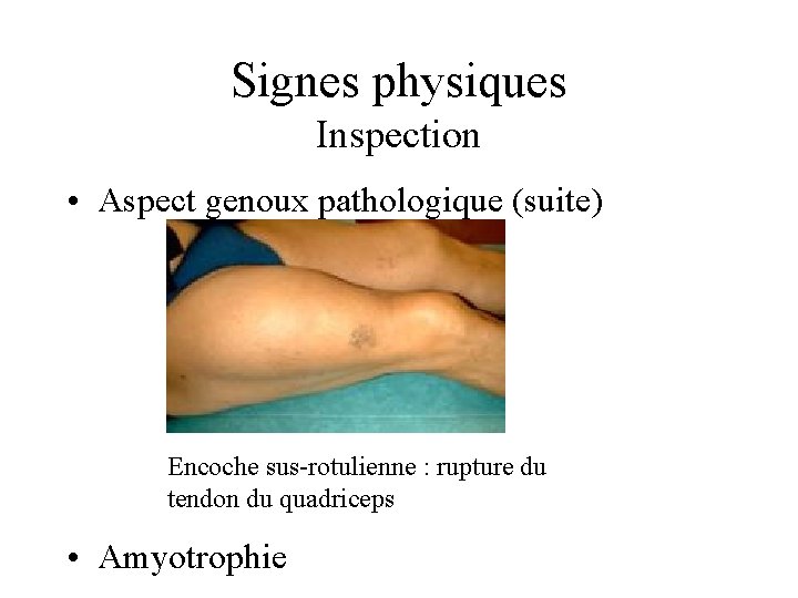 Signes physiques Inspection • Aspect genoux pathologique (suite) Encoche sus-rotulienne : rupture du tendon