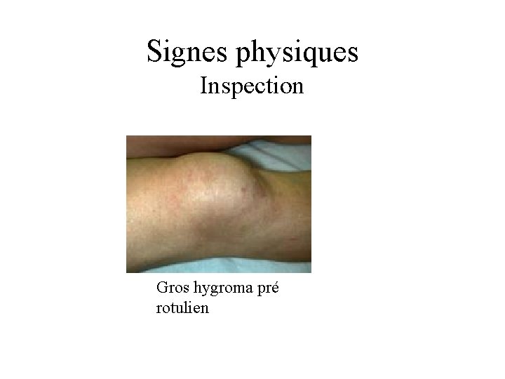 Signes physiques Inspection Gros hygroma pré rotulien 