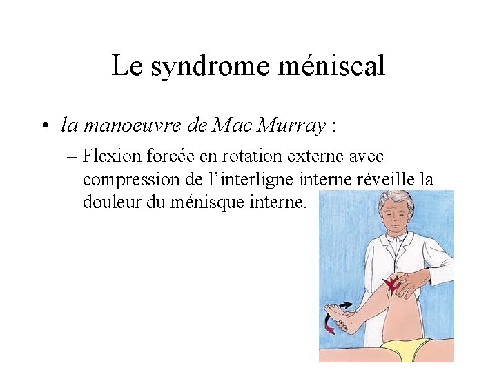 Le syndrome méniscal • la manoeuvre de Mac Murray : – Flexion forcée en