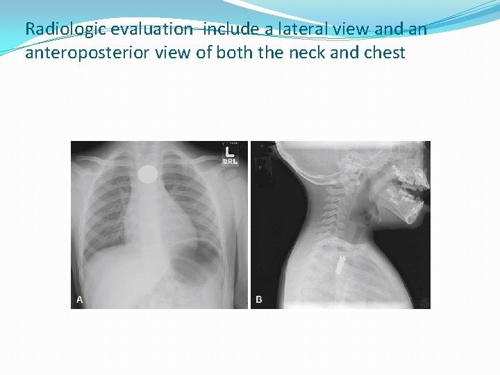 Radiologic evaluation include a lateral view and an anteroposterior view of both the neck