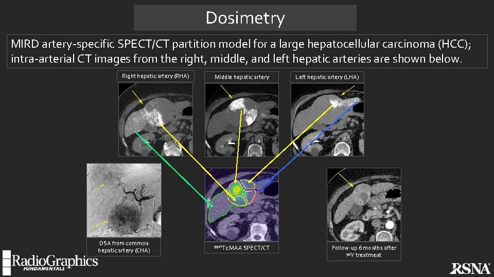 Dosimetry MIRD artery-specific SPECT/CT partition model for a large hepatocellular carcinoma (HCC); intra-arterial CT