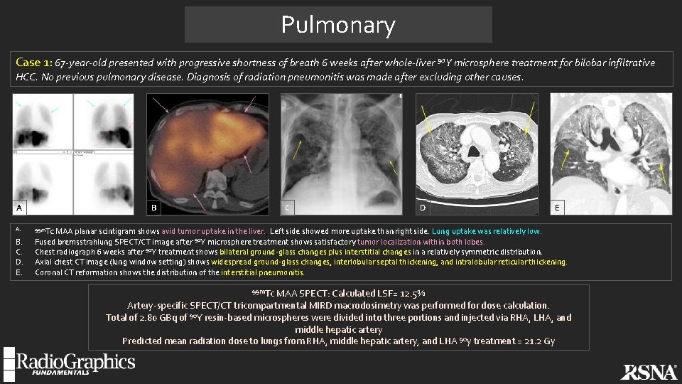 Pulmonary Case 1: 67 -year-old presented with progressive shortness of breath 6 weeks after