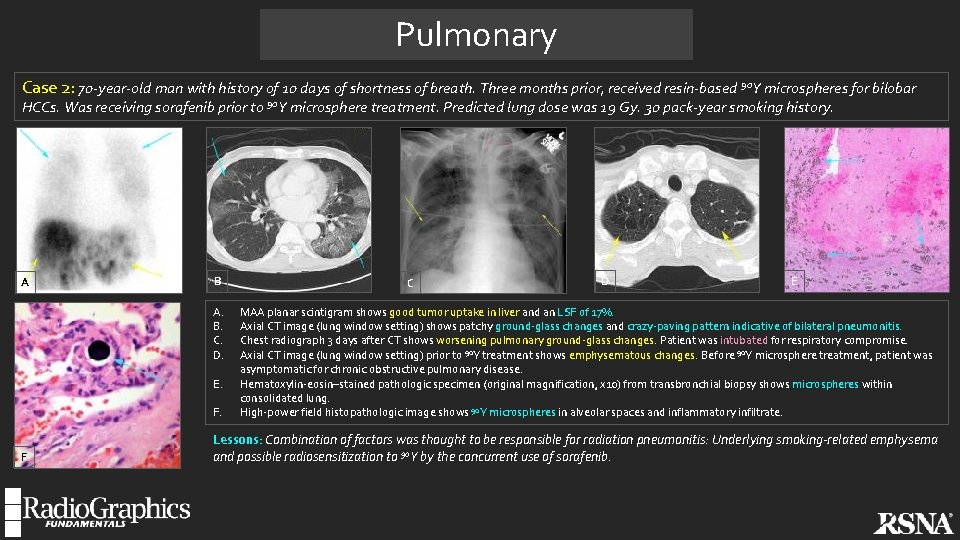 Pulmonary Case 2: 70 -year-old man with history of 10 days of shortness of