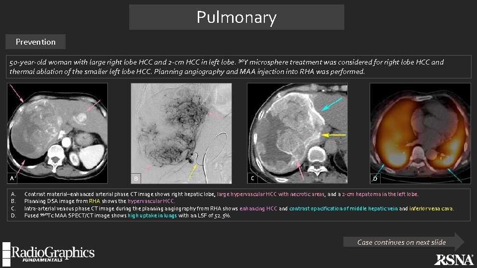 Pulmonary Prevention 50 -year-old woman with large right lobe HCC and 2 -cm HCC