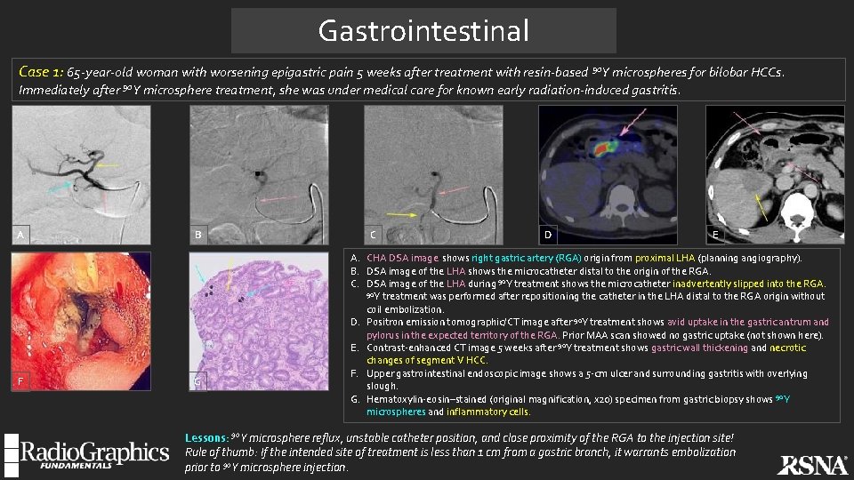 Gastrointestinal Case 1: 65 -year-old woman with worsening epigastric pain 5 weeks after treatment