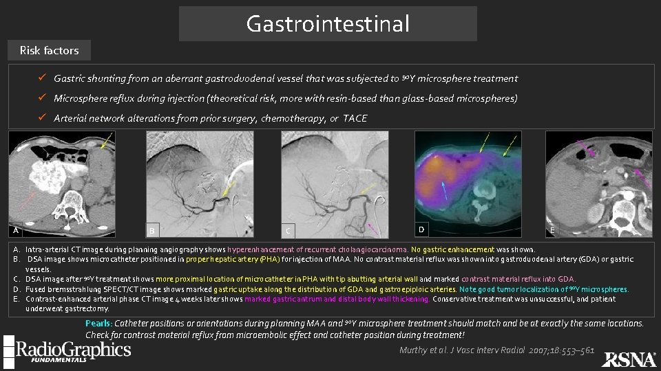 Gastrointestinal Risk factors ü Gastric shunting from an aberrant gastroduodenal vessel that was subjected