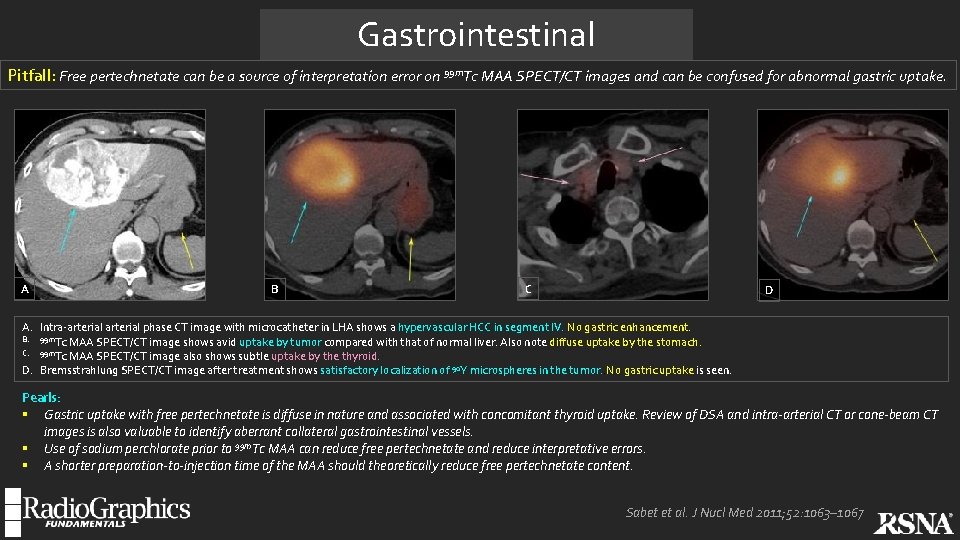 Gastrointestinal Pitfall: Free pertechnetate can be a source of interpretation error on 99 m.