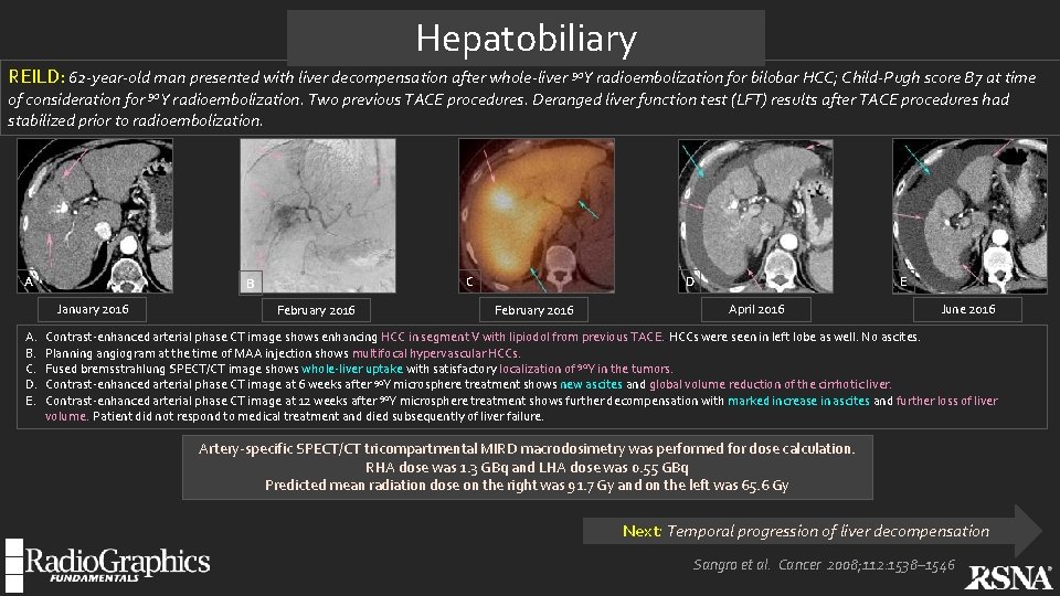 Hepatobiliary REILD: 62 -year-old man presented with liver decompensation after whole-liver 90 Y radioembolization