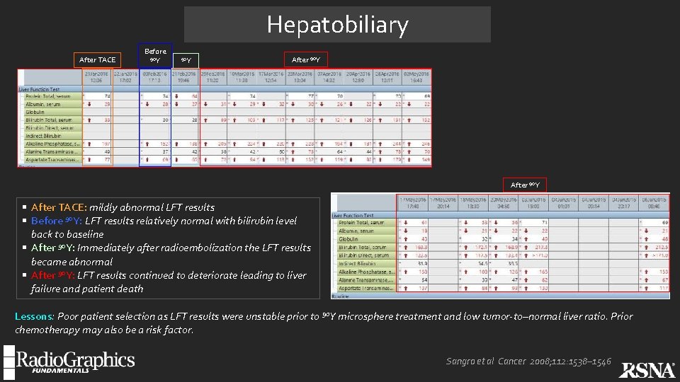 Hepatobiliary After TACE Before 90 Y After 90 Y § After TACE: mildly abnormal