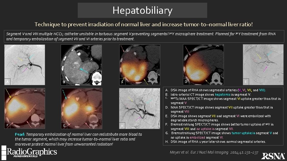 Hepatobiliary Technique to prevent irradiation of normal liver and increase tumor-to–normal liver ratio! Segment