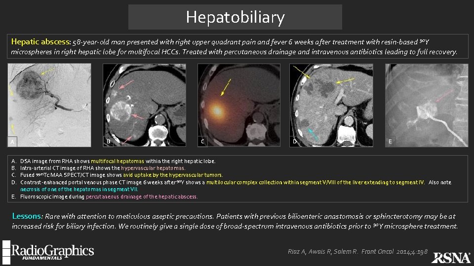 Hepatobiliary Hepatic abscess: 58 -year-old man presented with right upper quadrant pain and fever