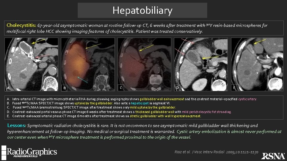 Hepatobiliary Cholecystitis: 67 -year-old asymptomatic woman at routine follow-up CT, 6 weeks after treatment