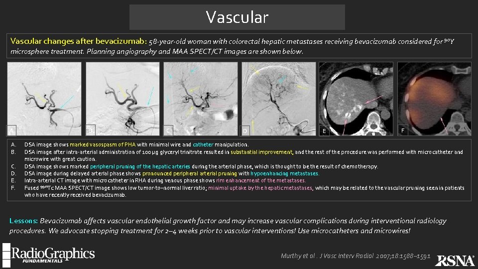 Vascular changes after bevacizumab: 58 -year-old woman with colorectal hepatic metastases receiving bevacizumab considered