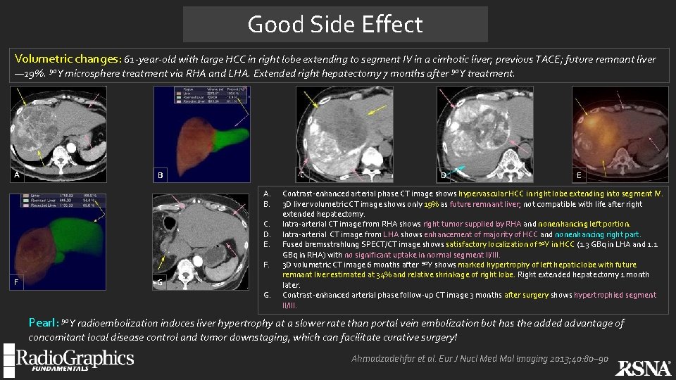 Good Side Effect Volumetric changes: 61 -year-old with large HCC in right lobe extending