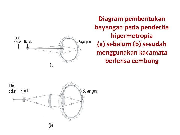 Diagram pembentukan bayangan pada penderita hipermetropia (a) sebelum (b) sesudah menggunakan kacamata berlensa cembung
