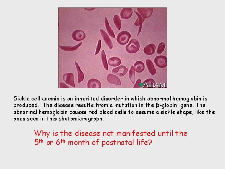 Sickle cell anemia is an inherited disorder in which abnormal hemoglobin is produced. The