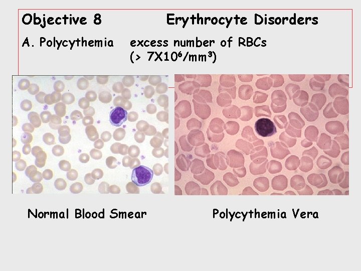 Objective 8 A. Polycythemia Erythrocyte Disorders excess number of RBCs (> 7 X 106/mm