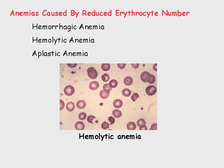 Anemias Caused By Reduced Erythrocyte Number Hemorrhagic Anemia Hemolytic Anemia Aplastic Anemia Hemolytic anemia