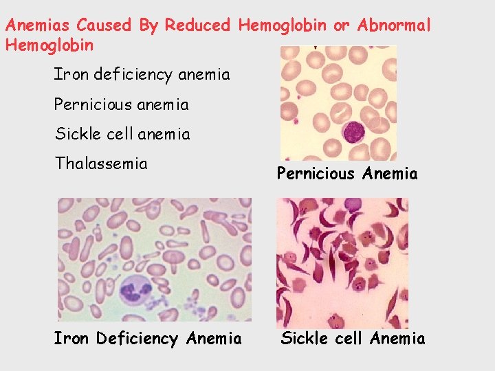 Anemias Caused By Reduced Hemoglobin or Abnormal Hemoglobin Iron deficiency anemia Pernicious anemia Sickle