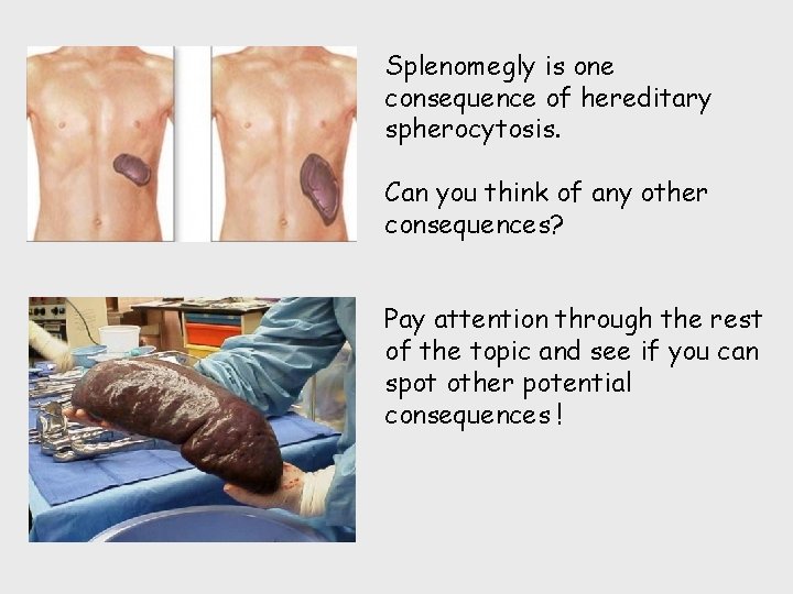 Splenomegly is one consequence of hereditary spherocytosis. Can you think of any other consequences?