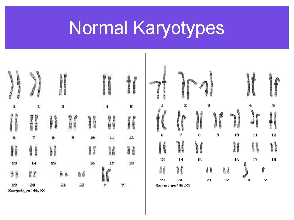 Normal Karyotypes 