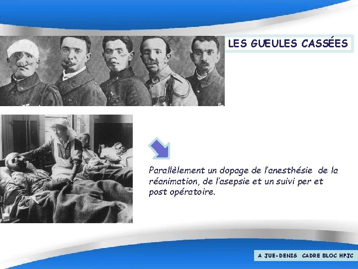 LES GUEULES CASSÉES Parallèlement un dopage de l’anesthésie de la réanimation, de l’asepsie et