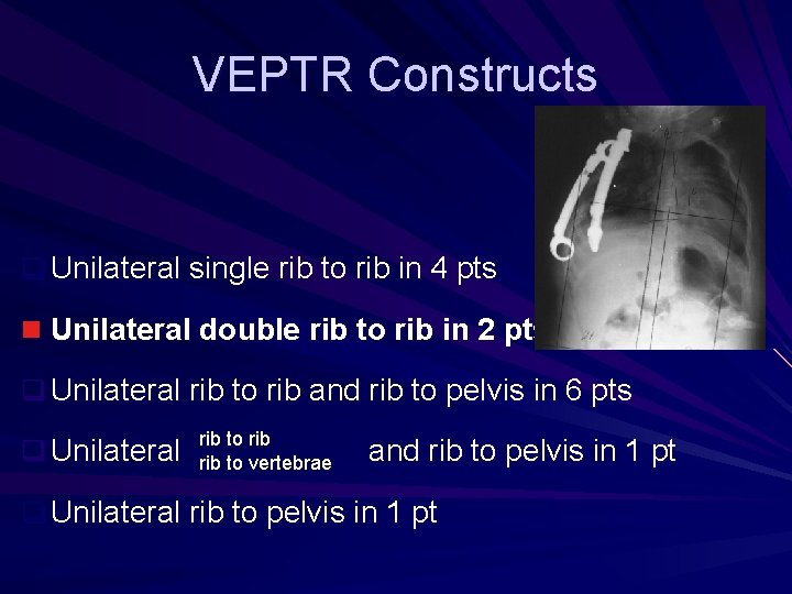VEPTR Constructs q Unilateral single rib to rib in 4 pts n Unilateral double VEPTR Constructs q Unilateral single rib to rib in 4 pts n Unilateral double