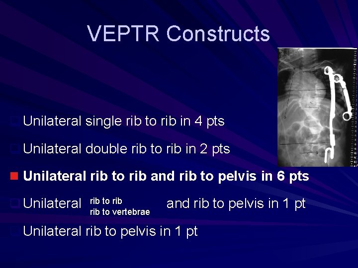 VEPTR Constructs q Unilateral single rib to rib in 4 pts q Unilateral double VEPTR Constructs q Unilateral single rib to rib in 4 pts q Unilateral double
