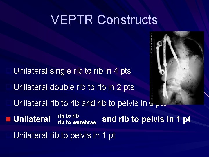 VEPTR Constructs q Unilateral single rib to rib in 4 pts q Unilateral double VEPTR Constructs q Unilateral single rib to rib in 4 pts q Unilateral double