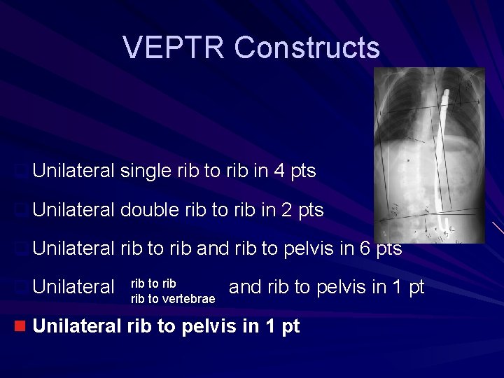 VEPTR Constructs q Unilateral single rib to rib in 4 pts q Unilateral double VEPTR Constructs q Unilateral single rib to rib in 4 pts q Unilateral double