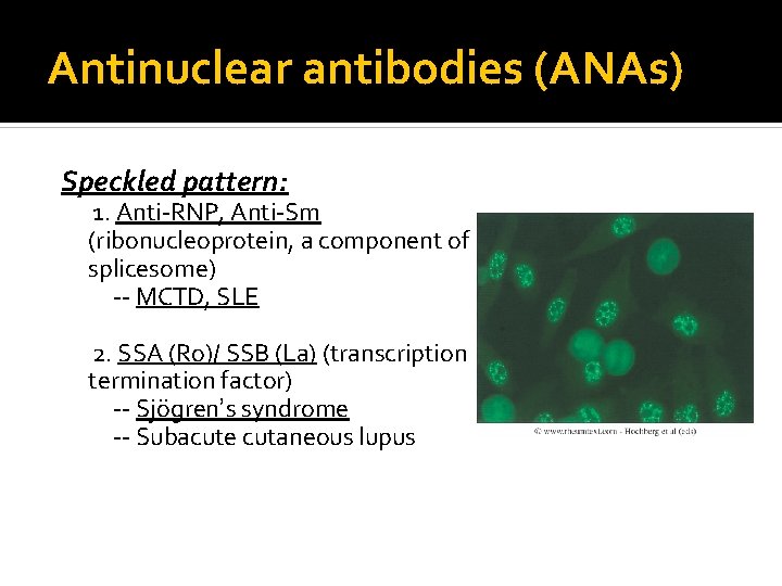 Antinuclear antibodies (ANAs) Speckled pattern: 1. Anti-RNP, Anti-Sm (ribonucleoprotein, a component of splicesome) --