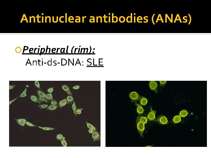 Antinuclear antibodies (ANAs) Peripheral (rim): Anti-ds-DNA: SLE 