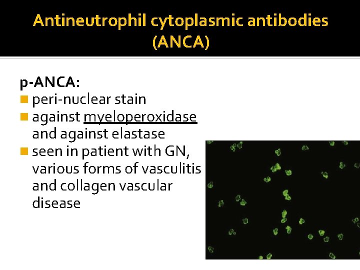 Antineutrophil cytoplasmic antibodies (ANCA) p-ANCA: n peri-nuclear stain n against myeloperoxidase and against elastase