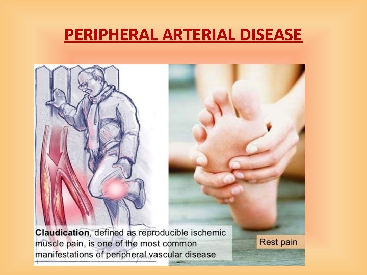 PERIPHERAL ARTERIAL DISEASE 