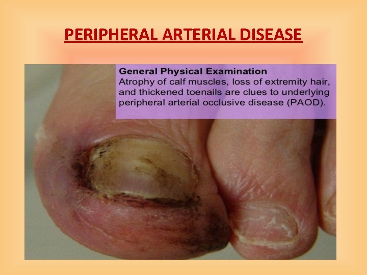 PERIPHERAL ARTERIAL DISEASE 