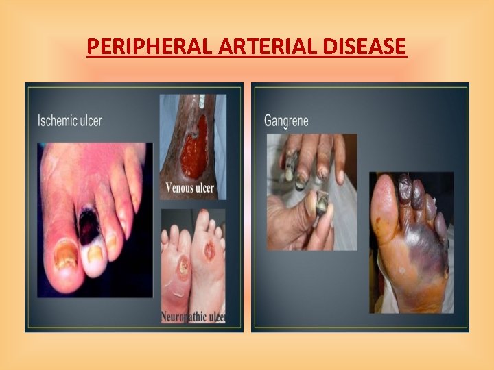 PERIPHERAL ARTERIAL DISEASE 