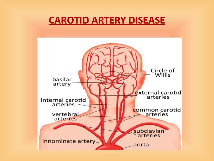 CAROTID ARTERY DISEASE 