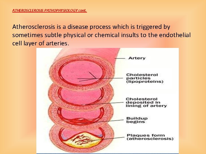 ATHEROSCLEROSIS PATHOPHYSIOLOGY cont. Atherosclerosis is a disease process which is triggered by sometimes subtle