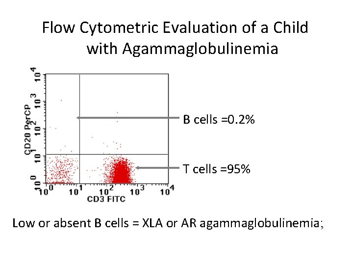 Flow Cytometric Evaluation of a Child with Agammaglobulinemia B cells =0. 2% T cells