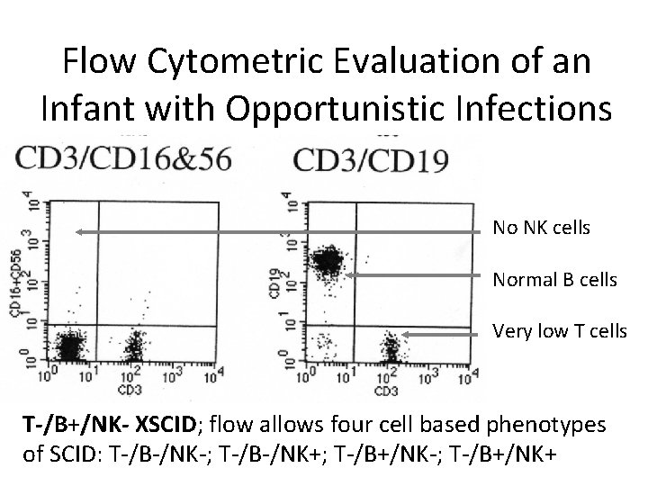 Flow Cytometric Evaluation of an Infant with Opportunistic Infections No NK cells Normal B
