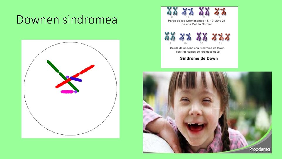 Downen sindromea 