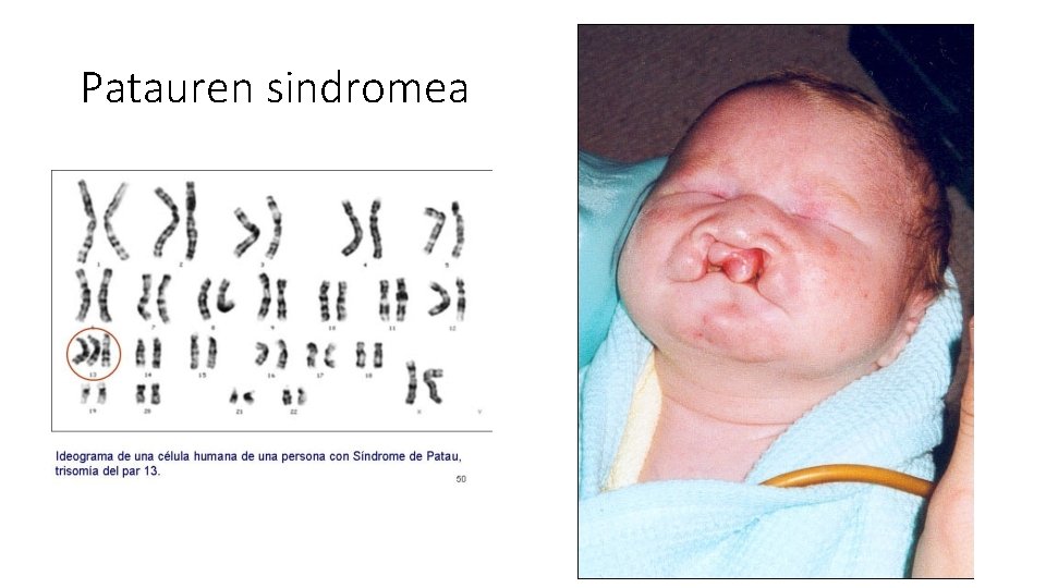 Patauren sindromea 
