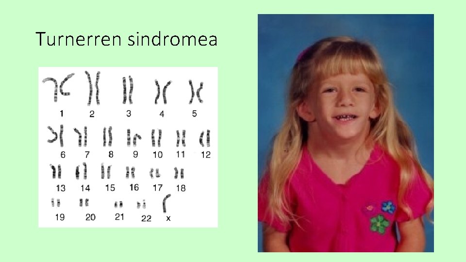 Turnerren sindromea 