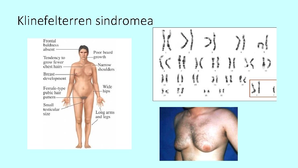 Klinefelterren sindromea 
