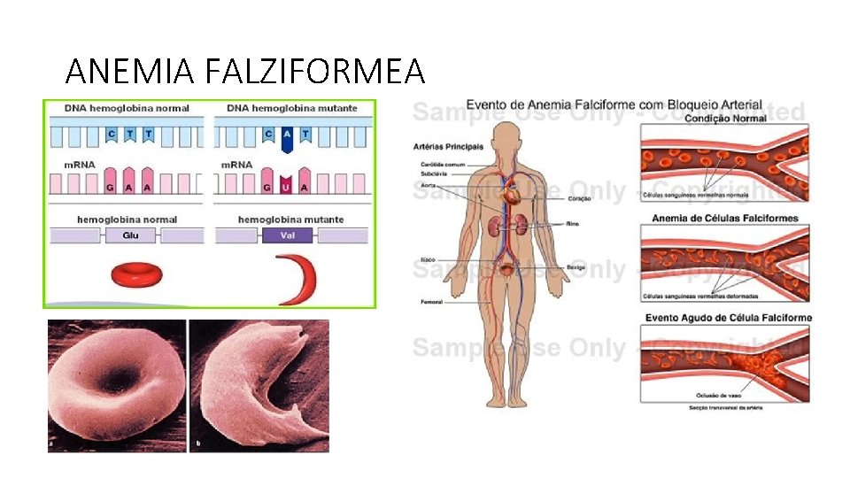 ANEMIA FALZIFORMEA 